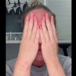žena očkování ekzém
