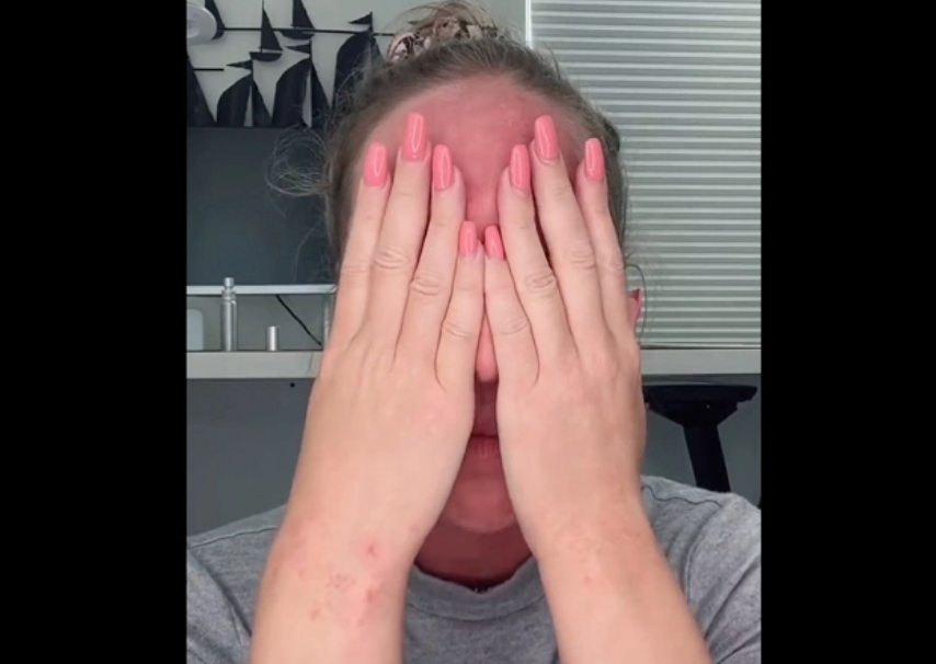 žena očkování ekzém